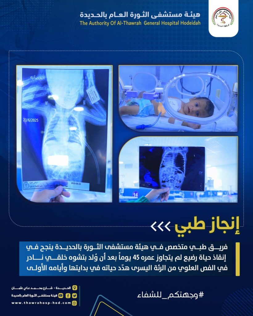 عملية جراحية نوعية ونادرة لرضيع بهيئة مستشفى الثورة بالحديدة تصنع الفارق
